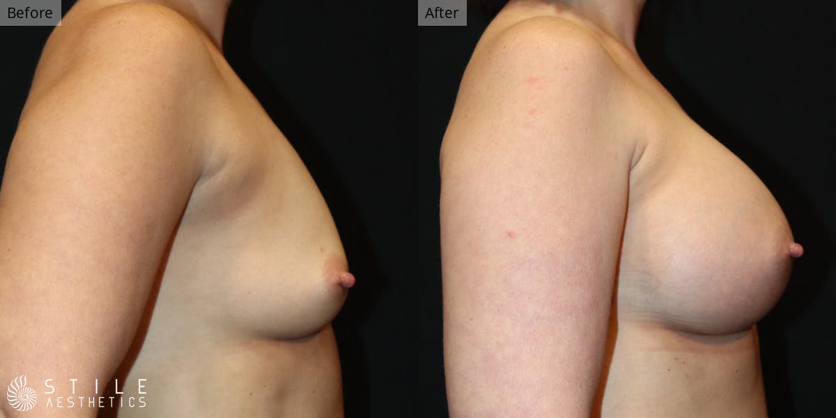 Breast Augmentation Before & After Gallery - Patient 314597 - Image 2