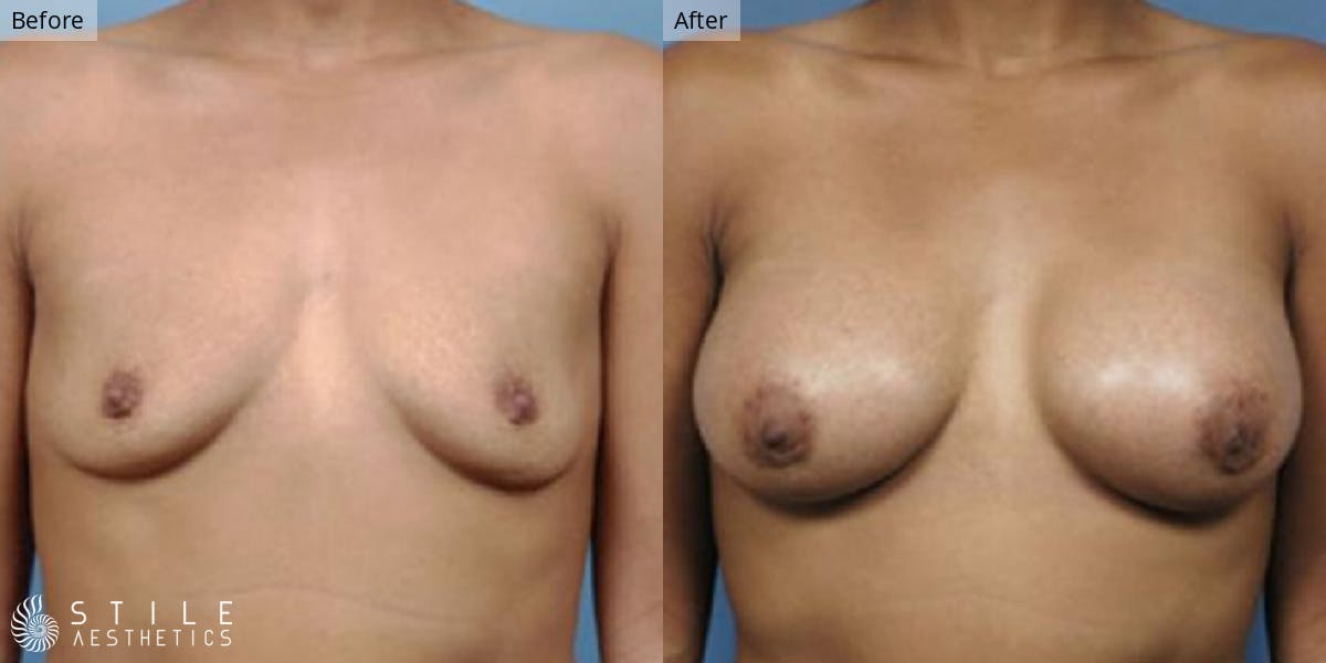 Breast Augmentation Before & After Gallery - Patient 370422 - Image 1