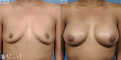 Breast Augmentation Before & After Gallery - Patient 370422 - Image 1