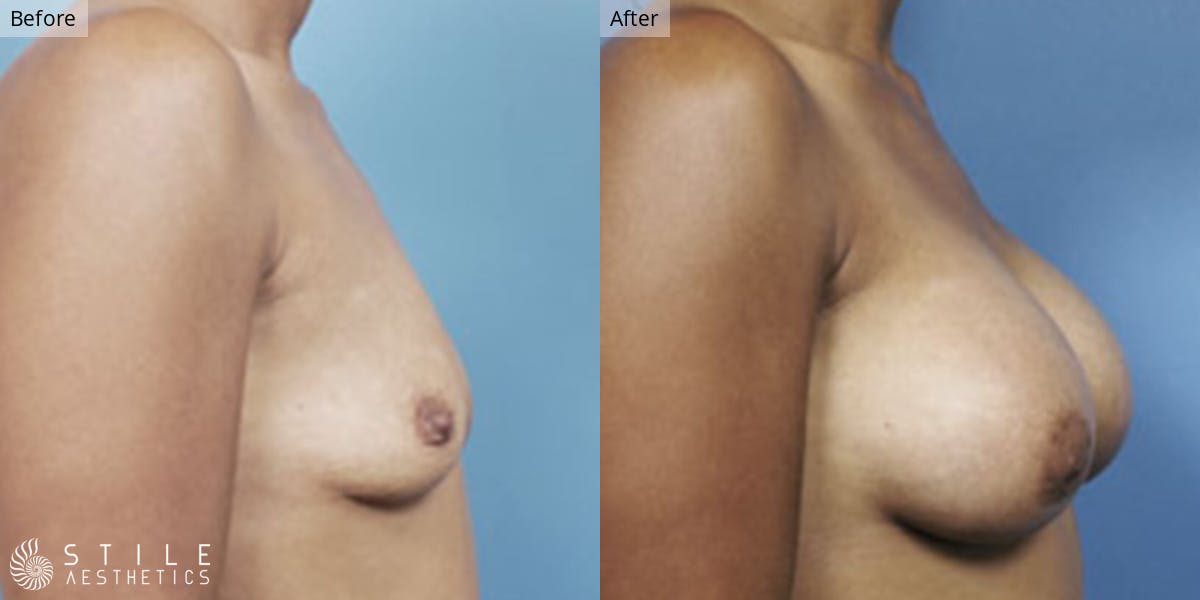 Breast Augmentation Before & After Gallery - Patient 370422 - Image 2