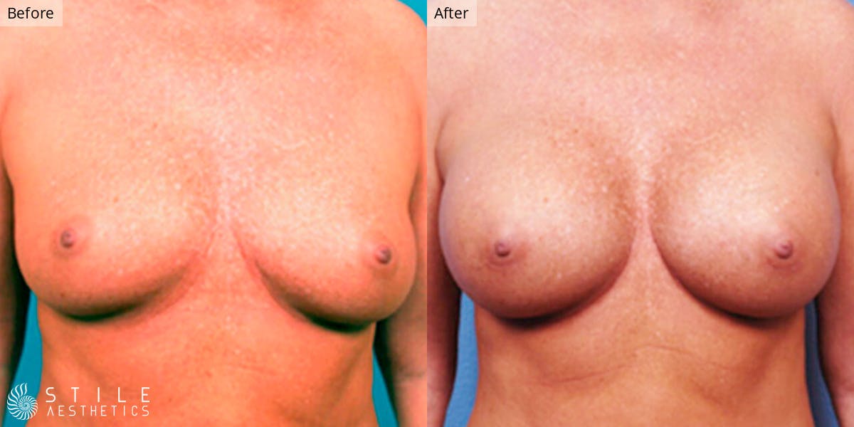 Breast Augmentation Before & After Gallery - Patient 426075 - Image 1