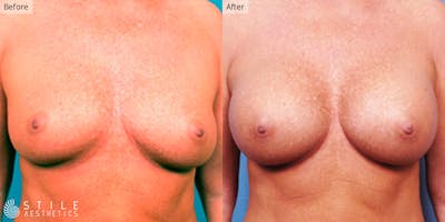 Breast Augmentation Before & After Gallery - Patient 426075 - Image 1