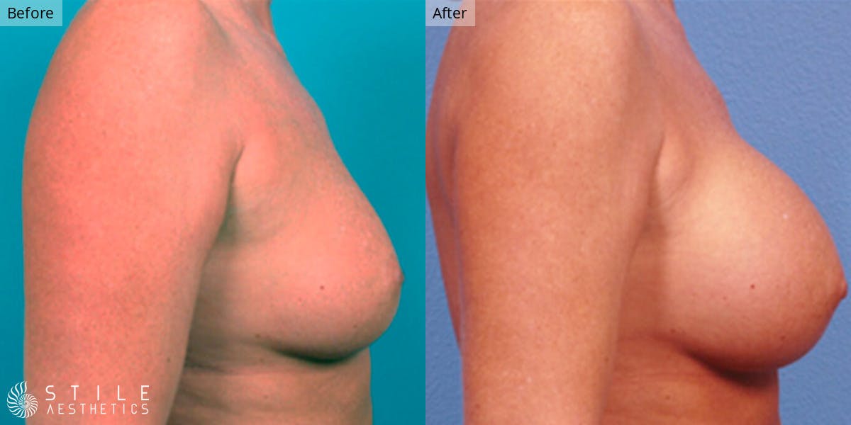 Breast Augmentation Before & After Gallery - Patient 426075 - Image 2