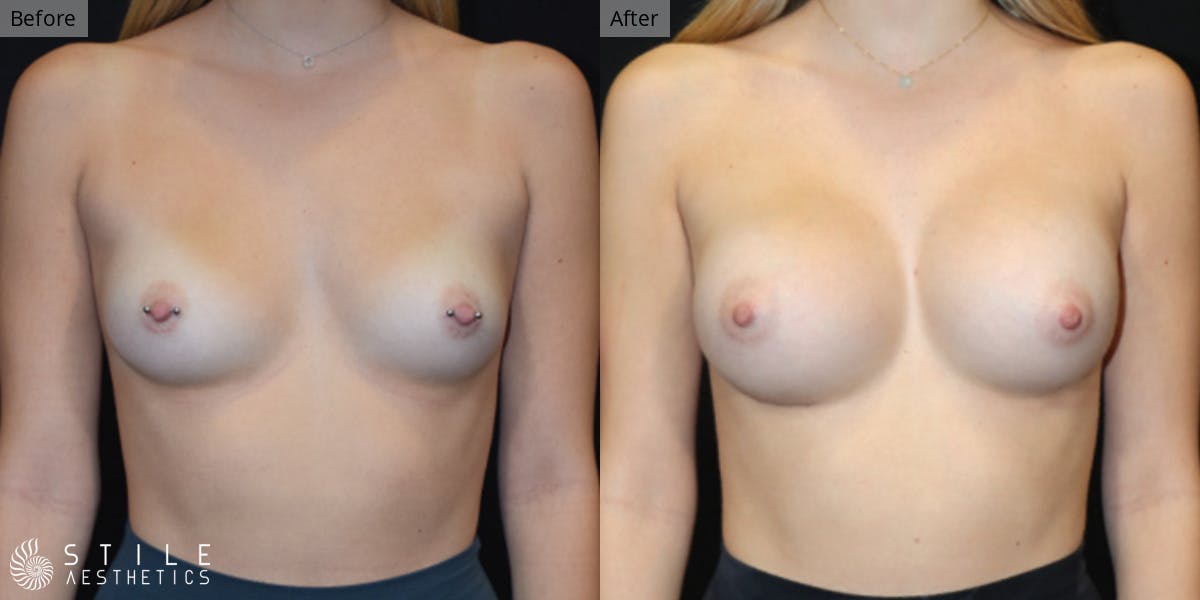 Breast Augmentation Before & After Gallery - Patient 209526 - Image 1
