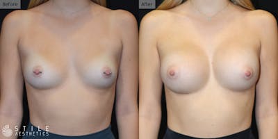 Breast Augmentation Before & After Gallery - Patient 209526 - Image 1