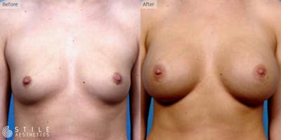Breast Augmentation Before & After Gallery - Patient 254945 - Image 1