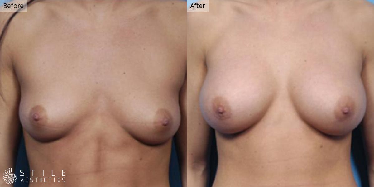 Breast Augmentation Before & After Gallery - Patient 278649 - Image 1