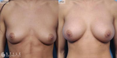 Breast Augmentation Before & After Gallery - Patient 278649 - Image 1
