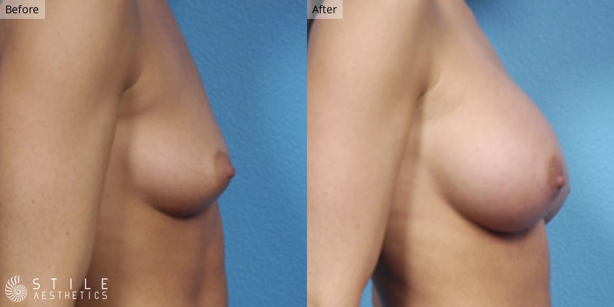 Breast Augmentation Before & After Gallery - Patient 278649 - Image 2