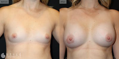 Breast Augmentation Before & After Gallery - Patient 205481 - Image 1