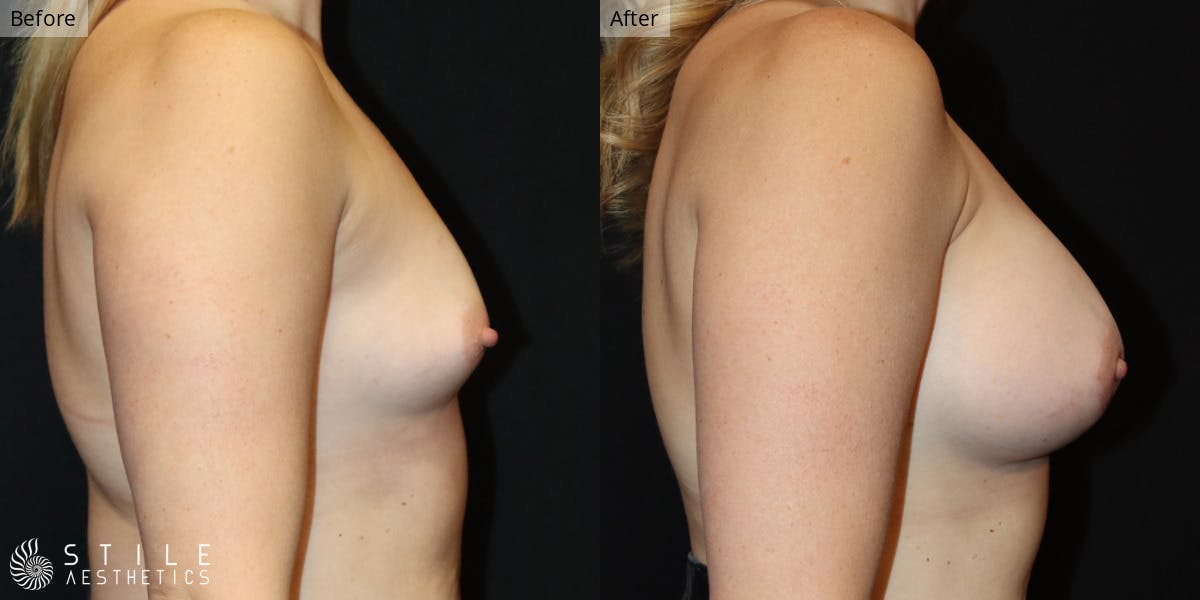 Breast Augmentation Before & After Gallery - Patient 205481 - Image 2