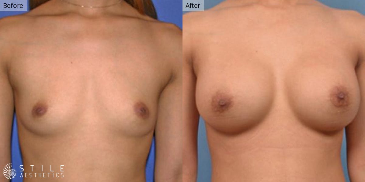 Breast Augmentation Before & After Gallery - Patient 340945 - Image 1