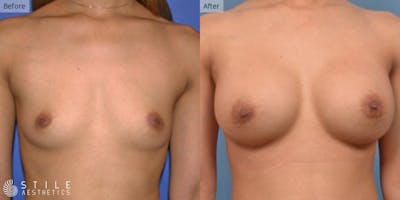 Breast Augmentation Before & After Gallery - Patient 340945 - Image 1
