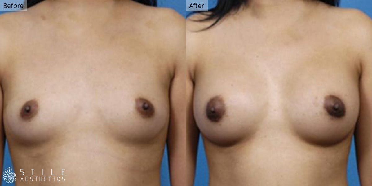 Breast Augmentation Before & After Gallery - Patient 293154 - Image 1