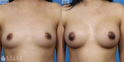 Breast Augmentation Before & After Gallery - Patient 293154 - Image 1