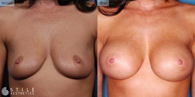 Breast Augmentation Before & After Gallery - Patient 298314 - Image 1