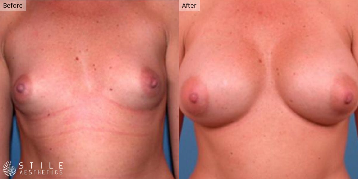 Breast Augmentation Before & After Gallery - Patient 342303 - Image 1