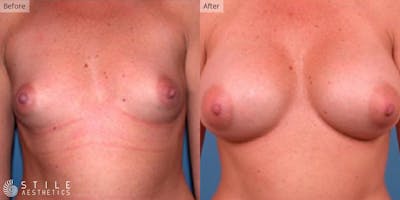 Breast Augmentation Before & After Gallery - Patient 342303 - Image 1