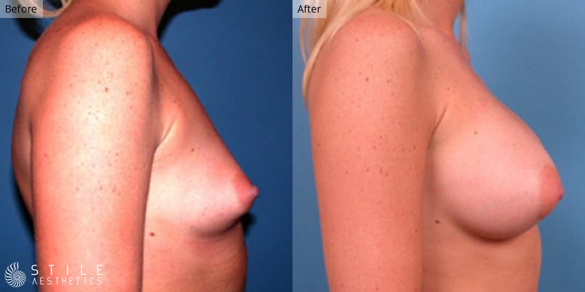 Breast Augmentation Before & After Gallery - Patient 342303 - Image 2