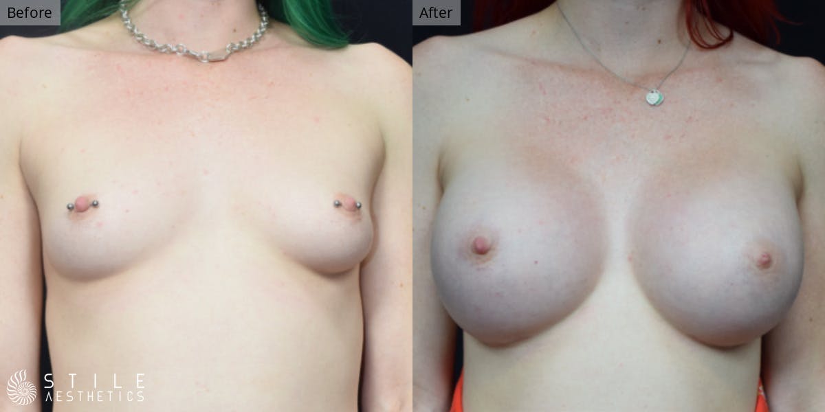 Breast Augmentation Before & After Gallery - Patient 360998 - Image 1