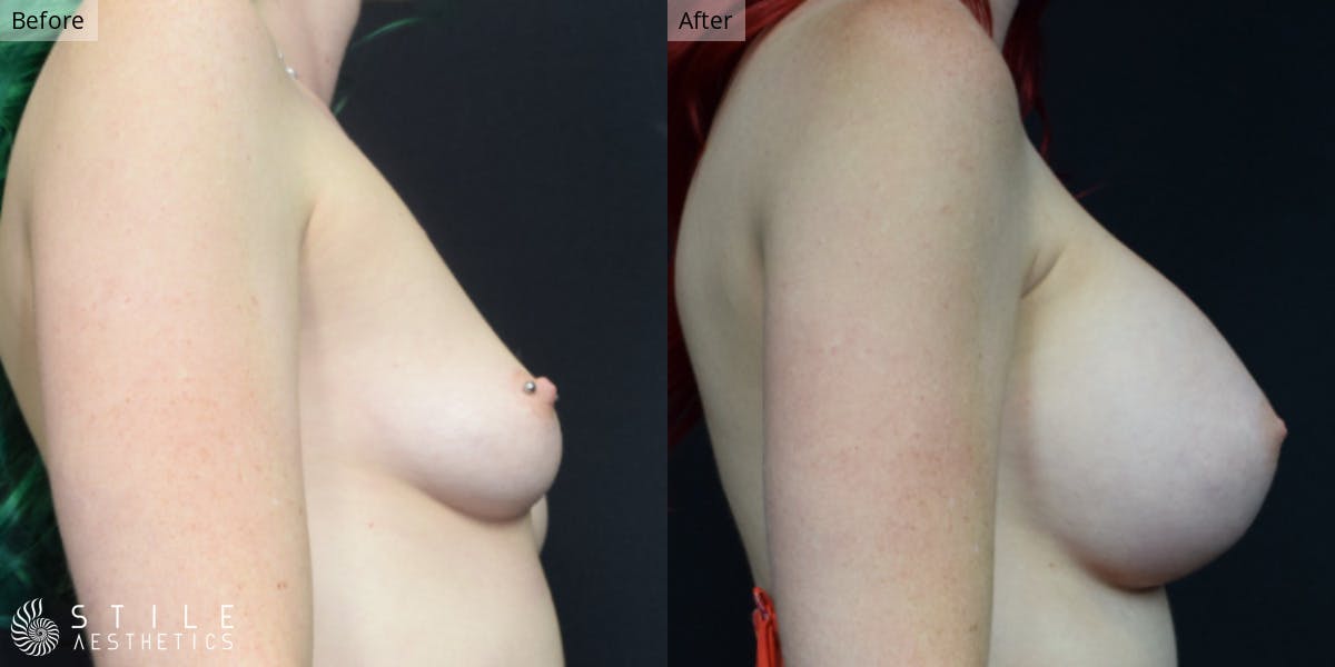 Breast Augmentation Before & After Gallery - Patient 360998 - Image 2