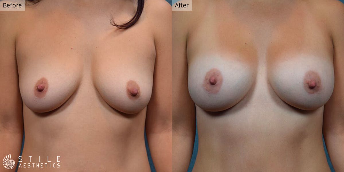 Breast Augmentation Before & After Gallery - Patient 276194 - Image 1