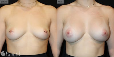 Breast Augmentation Before & After Gallery - Patient 130323 - Image 1