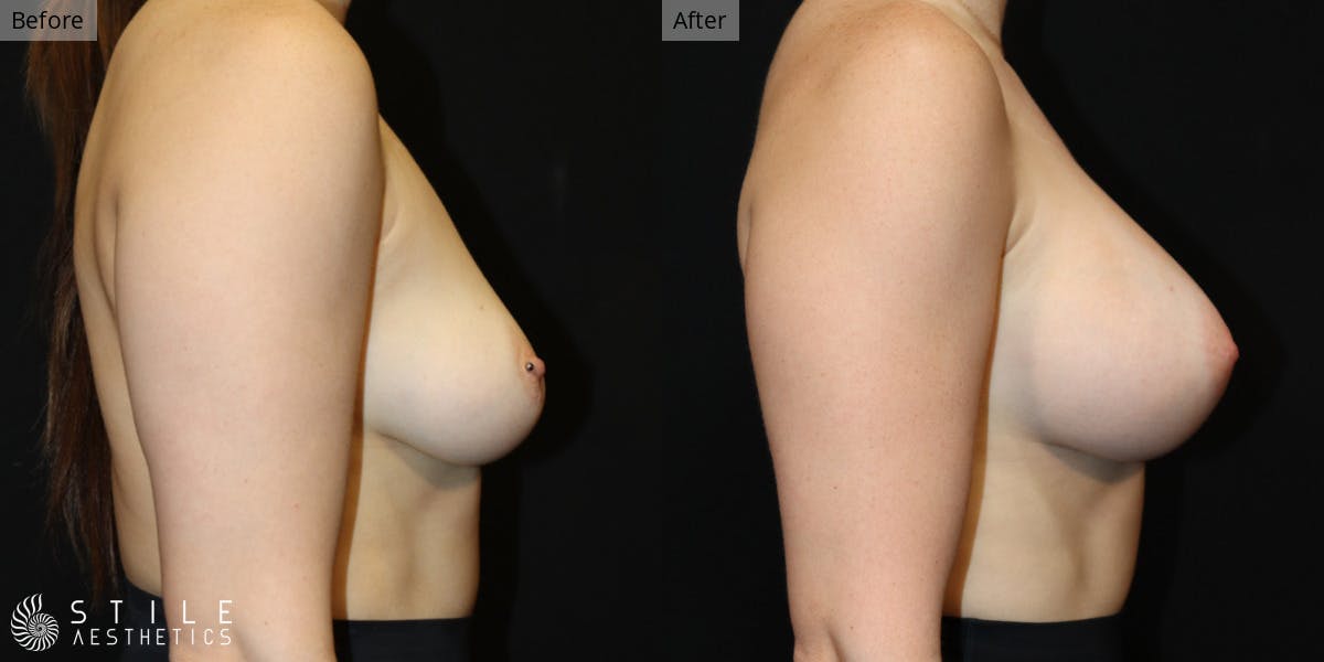 Breast Augmentation Before & After Gallery - Patient 130323 - Image 2