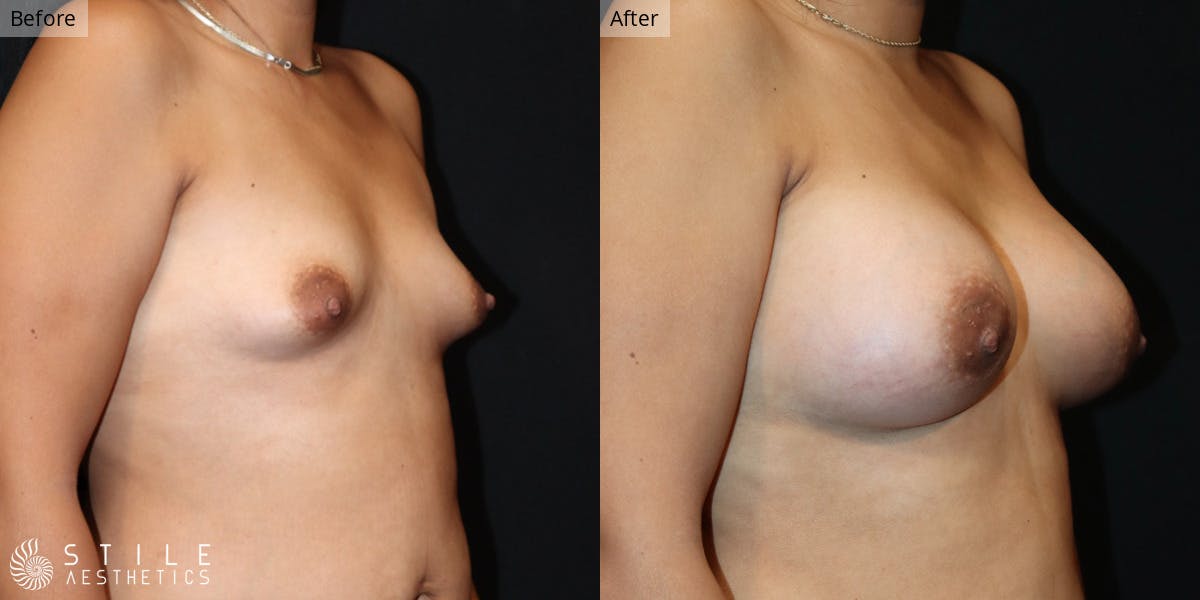 Breast Augmentation Before & After Gallery - Patient 457520 - Image 2