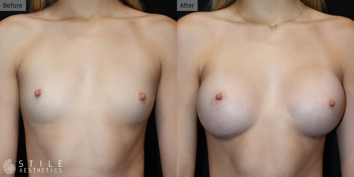 Breast Augmentation Before & After Gallery - Patient 328999 - Image 1