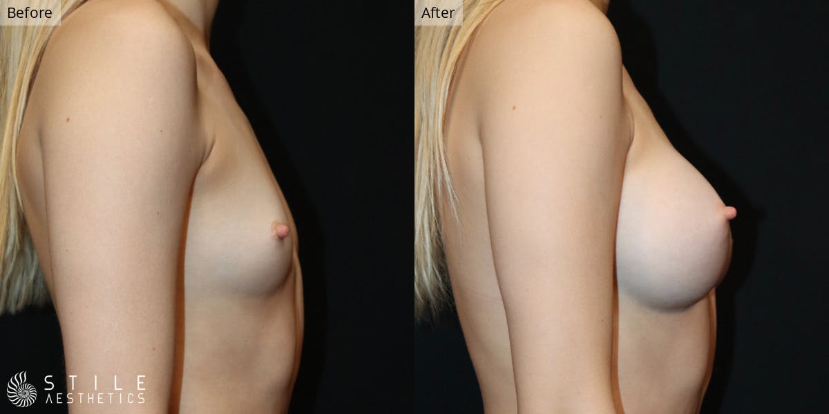 Breast Augmentation Before & After Gallery - Patient 328999 - Image 2