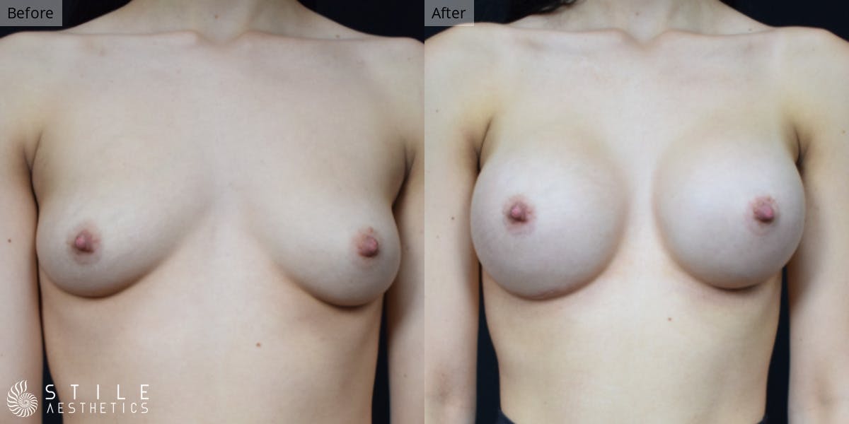 Breast Augmentation Before & After Gallery - Patient 794921 - Image 1