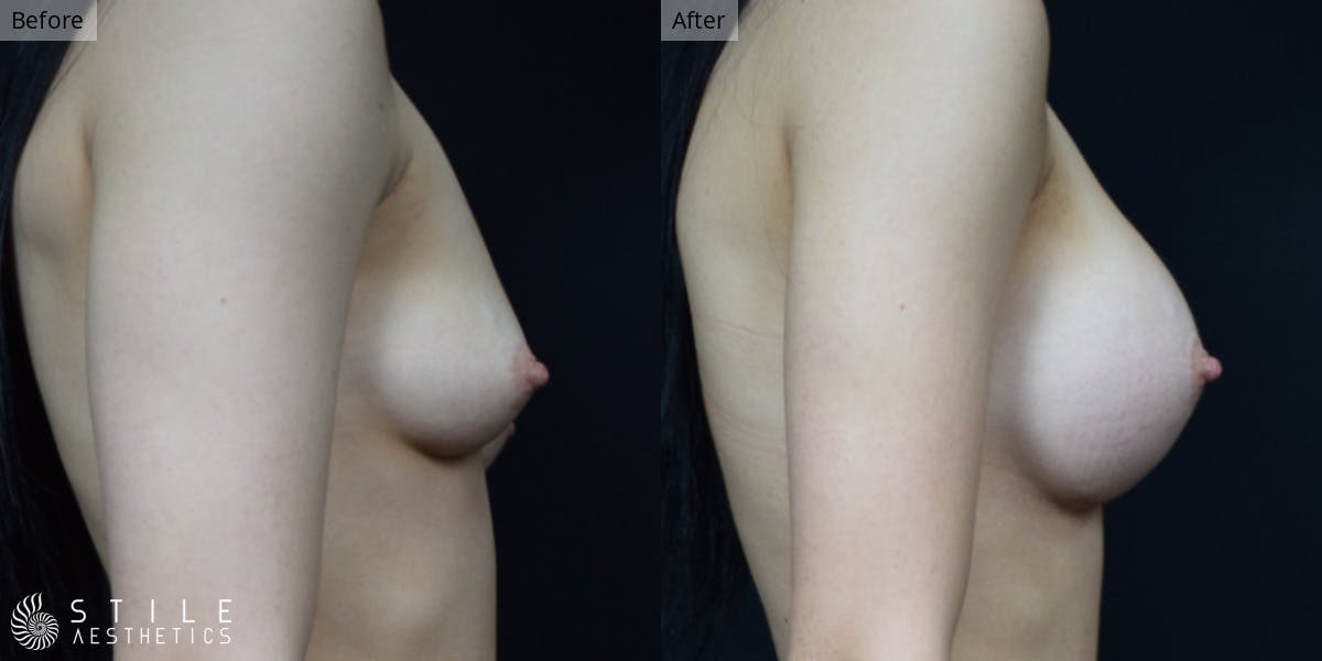 Breast Augmentation Before & After Gallery - Patient 794921 - Image 2
