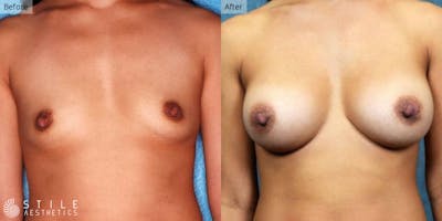 Breast Augmentation Before & After Gallery - Patient 317775 - Image 1