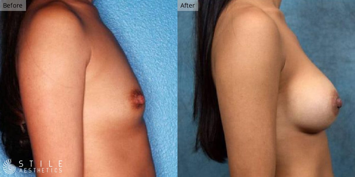 Breast Augmentation Before & After Gallery - Patient 317775 - Image 2