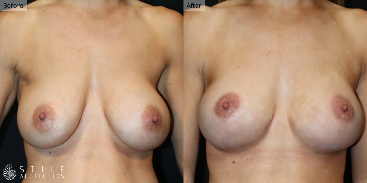 Breast Augmentation Before & After Gallery - Patient 217506 - Image 1