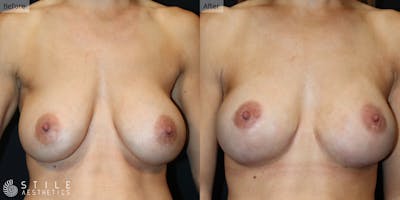 Breast Augmentation Before & After Gallery - Patient 217506 - Image 1