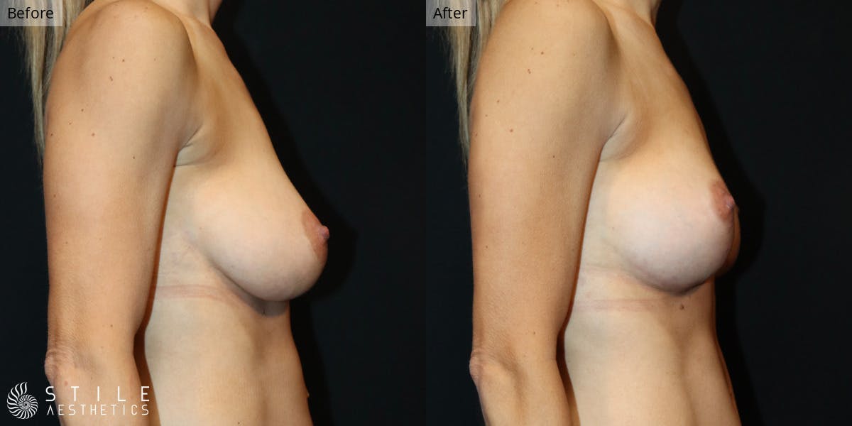 Breast Augmentation Before & After Gallery - Patient 217506 - Image 2