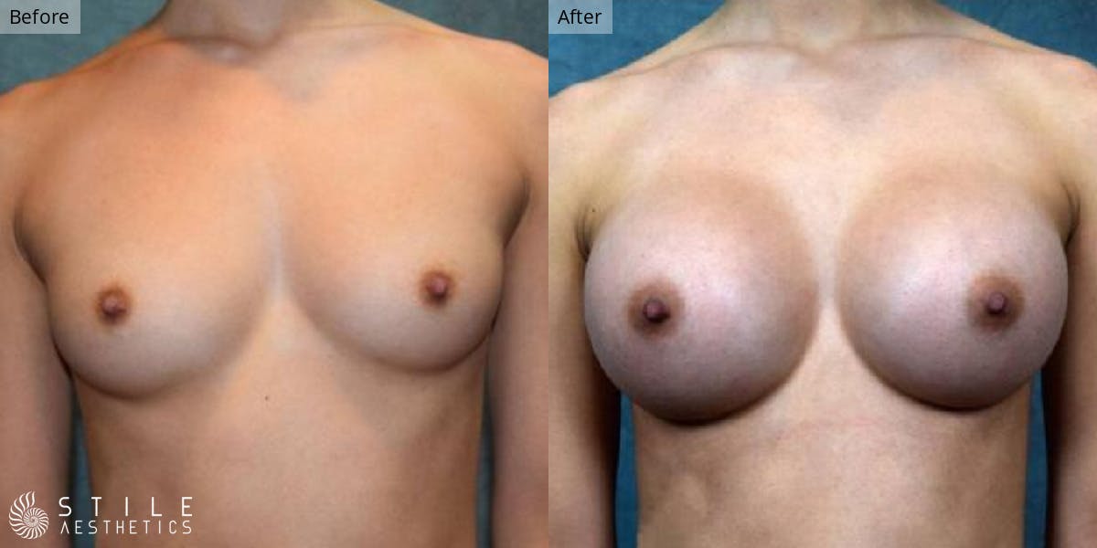 Breast Augmentation Before & After Gallery - Patient 134995 - Image 1