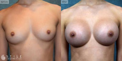 Breast Augmentation Before & After Gallery - Patient 134995 - Image 1