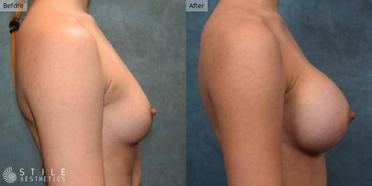 Breast Augmentation Before & After Gallery - Patient 134995 - Image 2