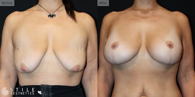 Breast Augmentation with Lift Before & After Gallery - Patient 441483 - Image 1