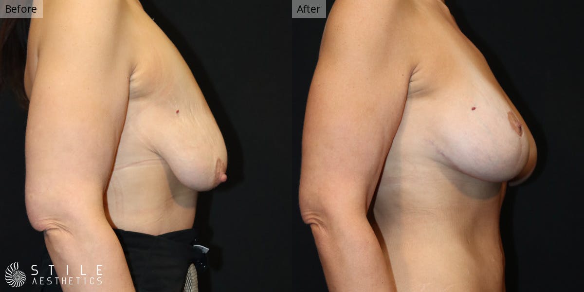 Breast Augmentation with Lift Before & After Gallery - Patient 441483 - Image 2