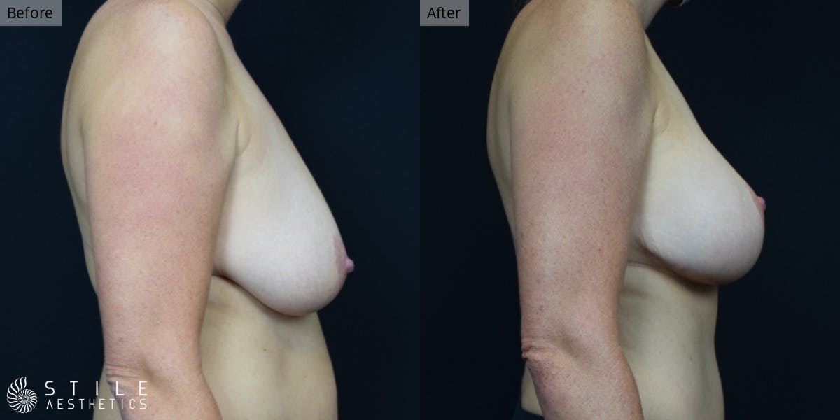 Breast Augmentation with Lift Before & After Gallery - Patient 134307 - Image 2