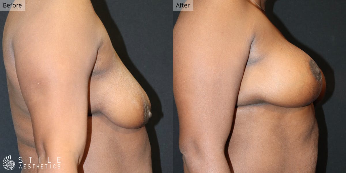 Breast Augmentation with Lift Before & After Gallery - Patient 557144 - Image 2