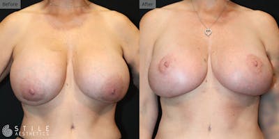 Breast Augmentation with Lift Before & After Gallery - Patient 260490 - Image 1