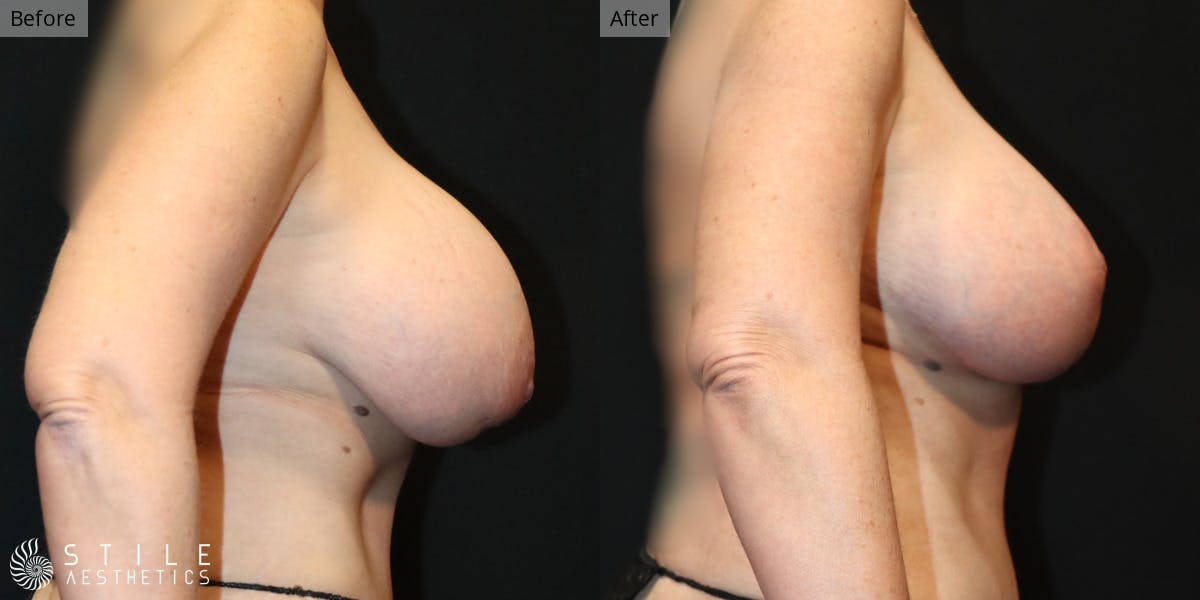 Breast Augmentation with Lift Before & After Gallery - Patient 213981 - Image 2