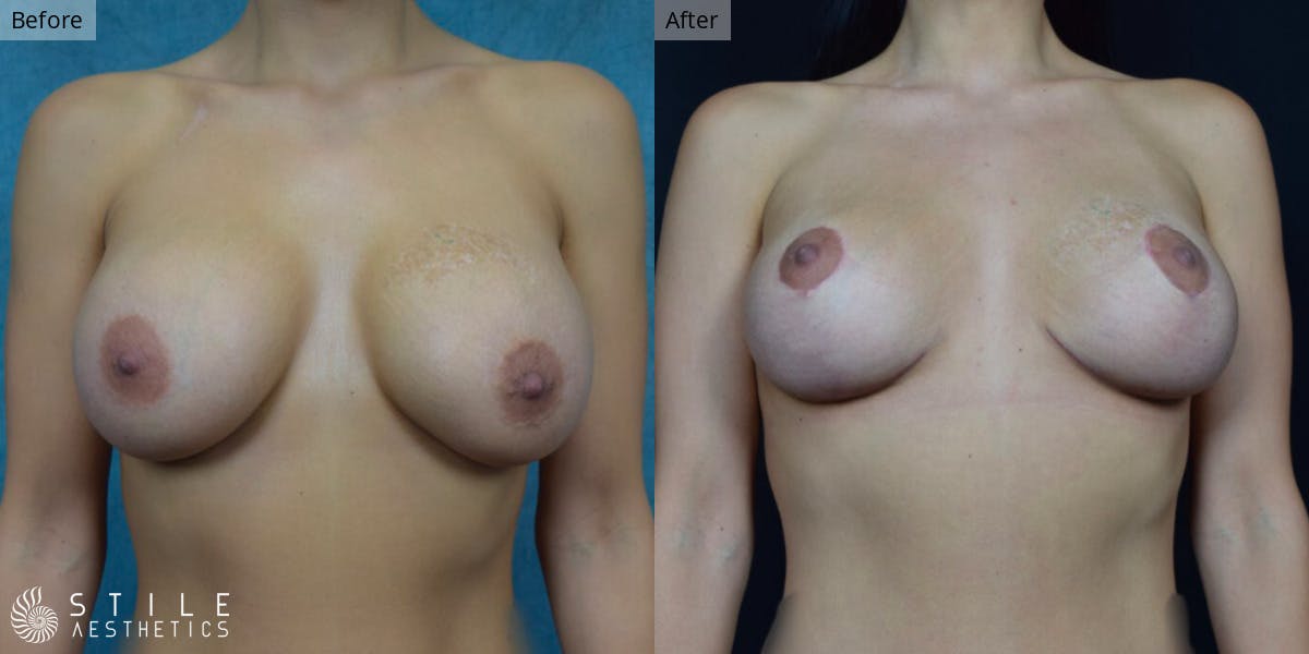 Breast Augmentation with Lift Before & After Gallery - Patient 711874 - Image 1