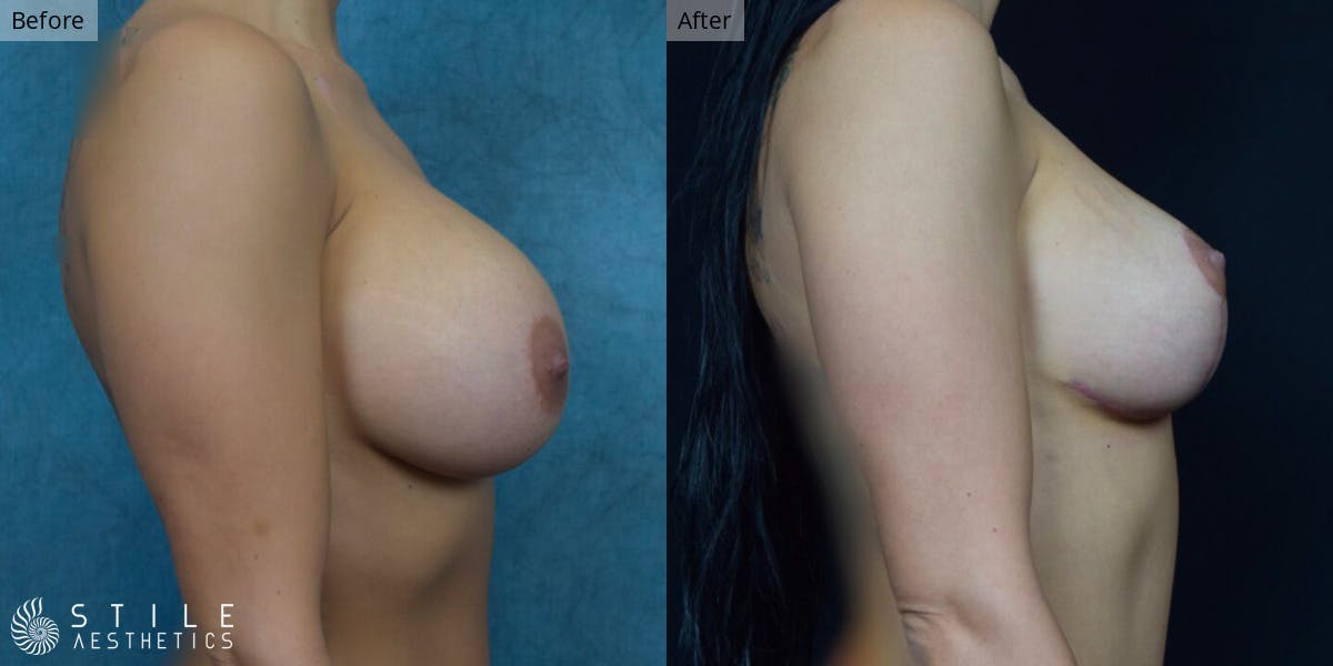 Breast Augmentation with Lift Before & After Gallery - Patient 711874 - Image 2