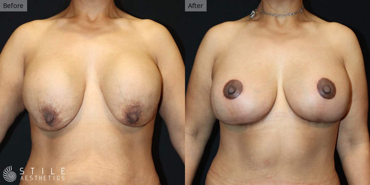 Breast Augmentation with Lift Before & After Gallery - Patient 394706 - Image 1
